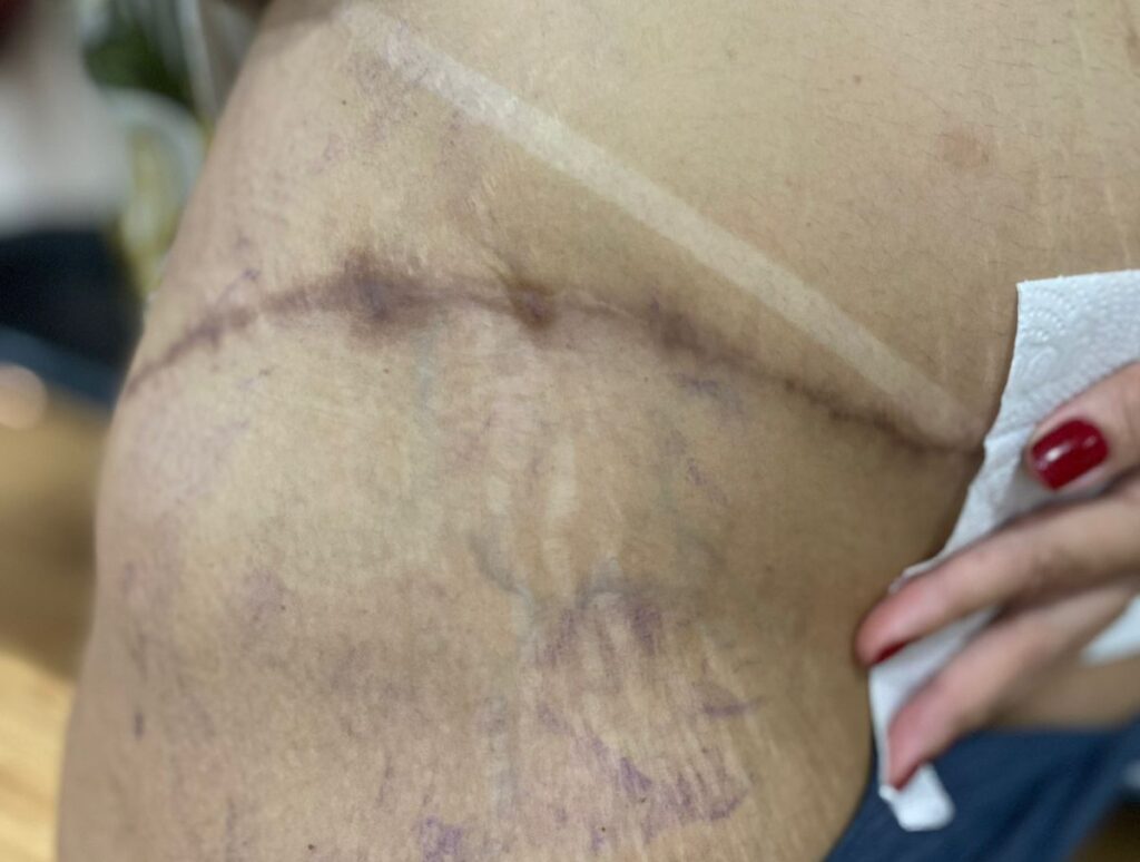 Cobertura de Cicatriz 24
